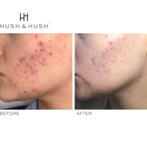 HUSH & HUSH SkinCapsule™ CLEAR+