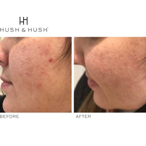 HUSH & HUSH SkinCapsule™ CLEAR+